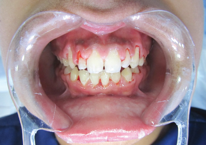 A Case of malocclusion, Class II D1 subdivision left side.